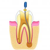 hammas juurihoito kuva