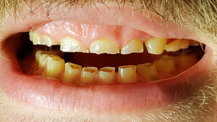 energiajuomat syöpyneet hampaat