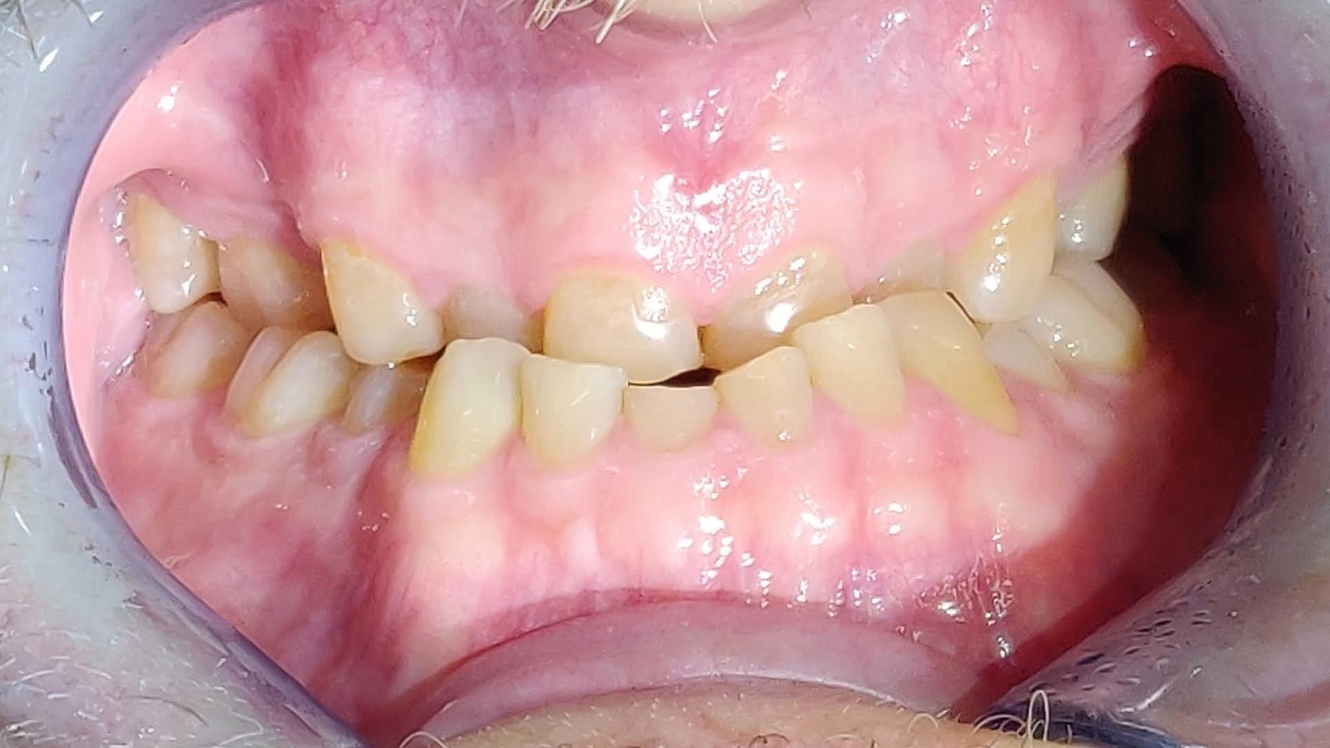 purentavirhe, ristipurenta