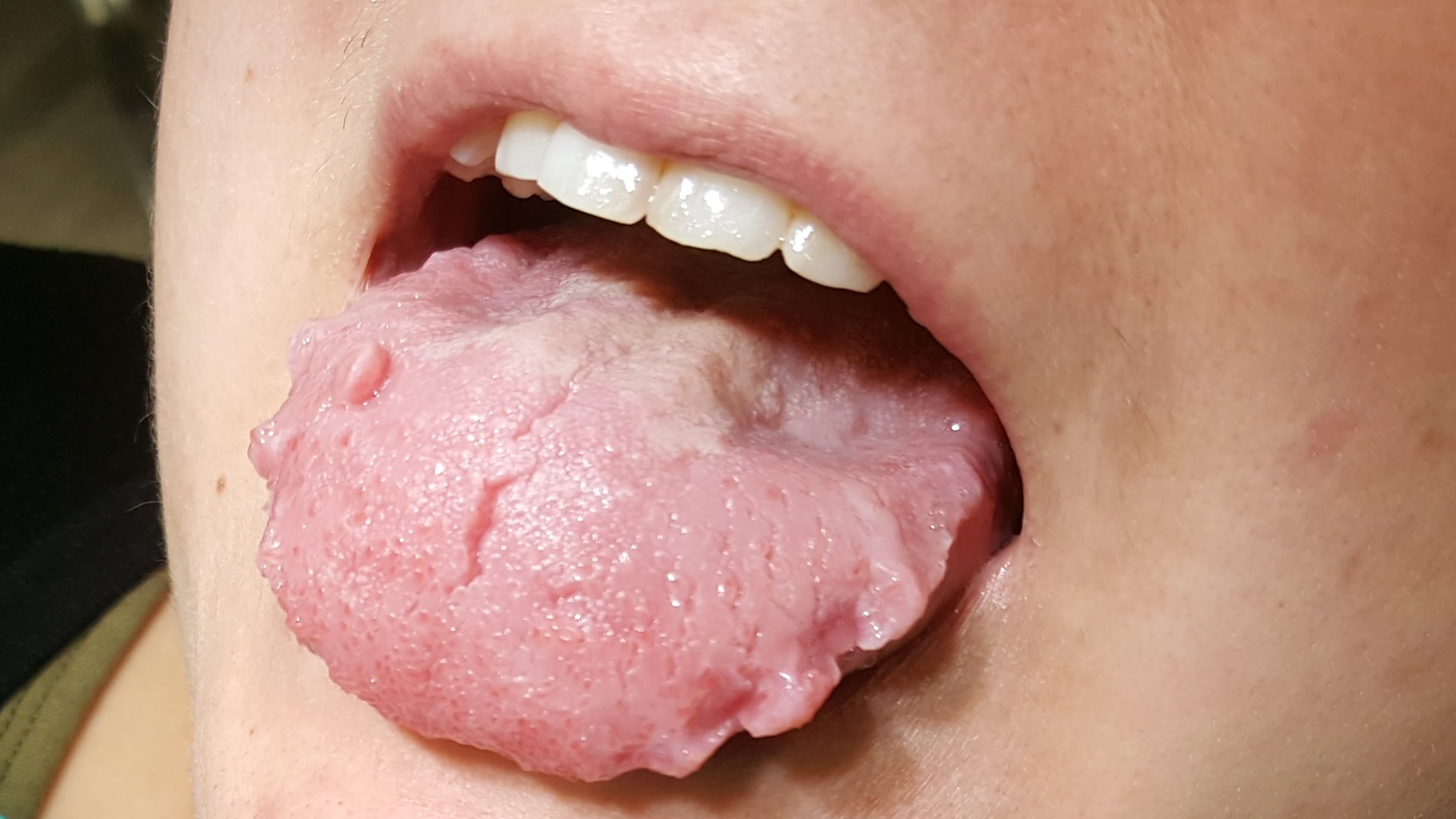 Yönarskuttelun, bruksisimin tuloksena piparkakkukieli